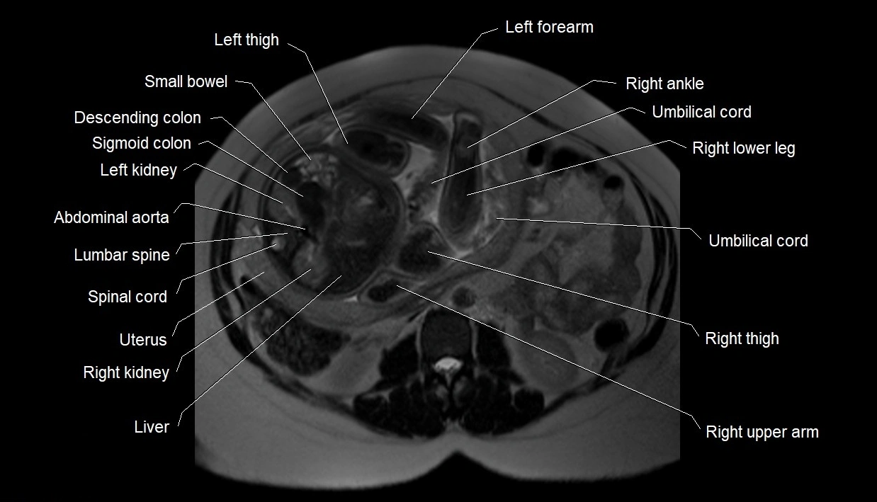 MRI fetal anatomy axial image 9.webp